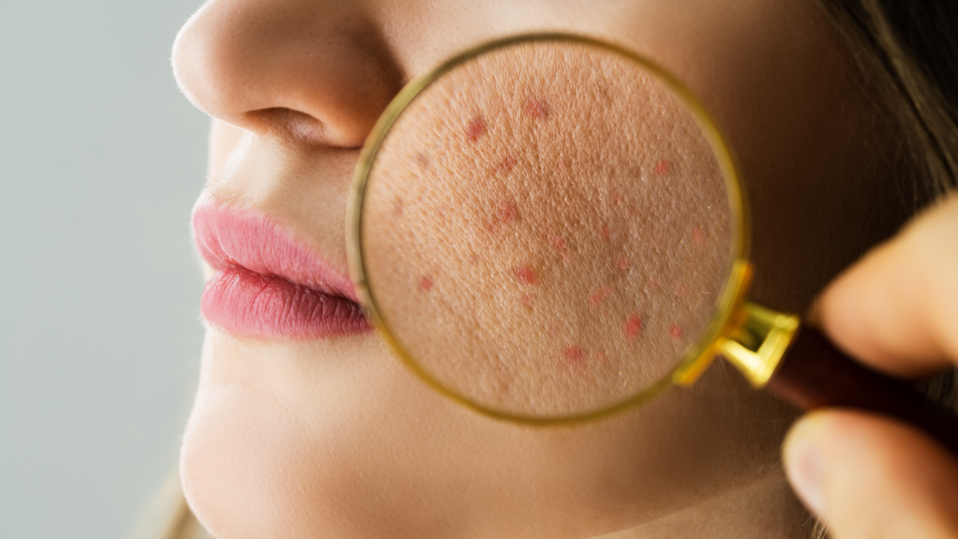 The Transformative Impact of Biologic Therapies on Chronic Skin Conditions