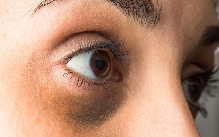 Understanding and Managing Dark Circles: Causes, Treatments, and Prevention